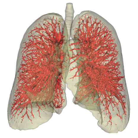 Exemple d'un arbre vasculaire pulmonaire extrait à partir d'une acquisition scanner angiographique